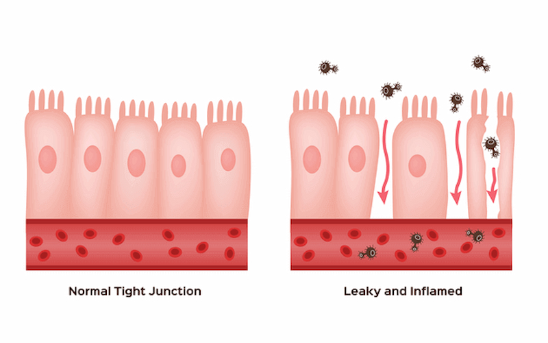 Leaky Gut Syndrome