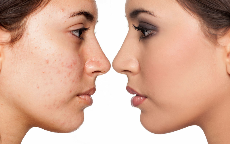 Functional medicine center Atlanta treatment for acne